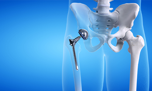 hipjoints
